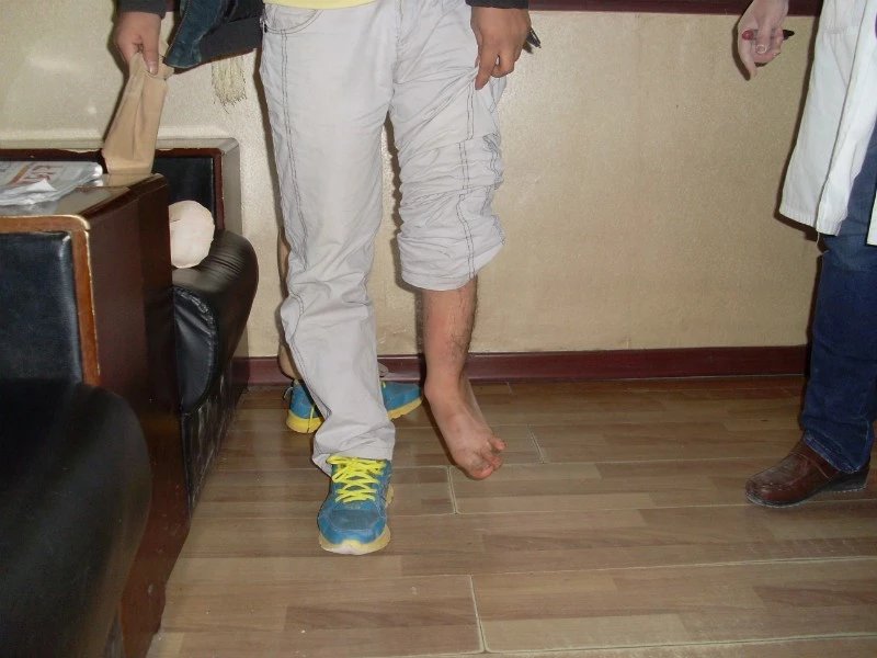 畸形腿、長(zhǎng)短腿(圖1)